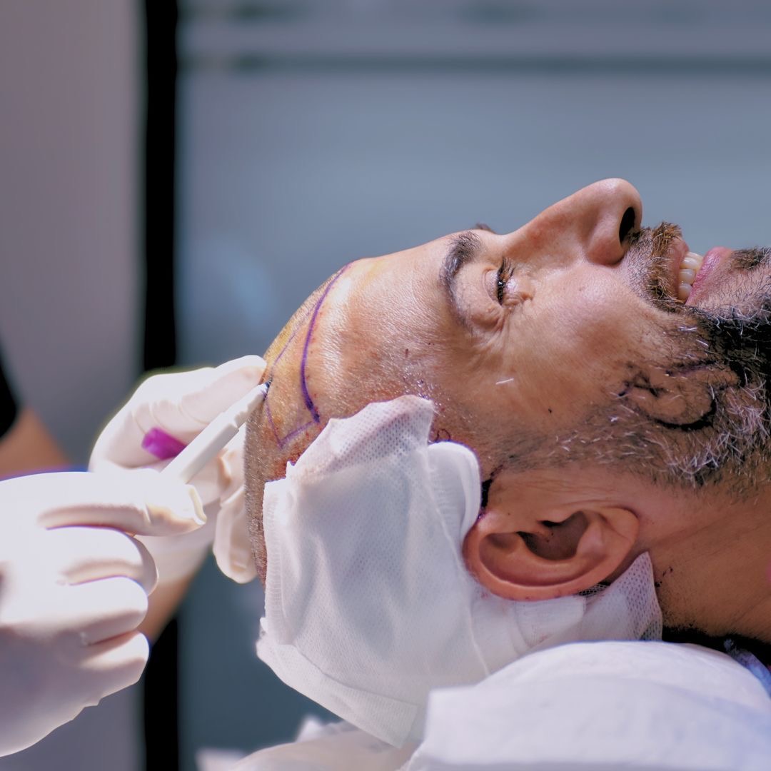 Mbjellja e flokëve në Shqipëri - Klinika Dermolife