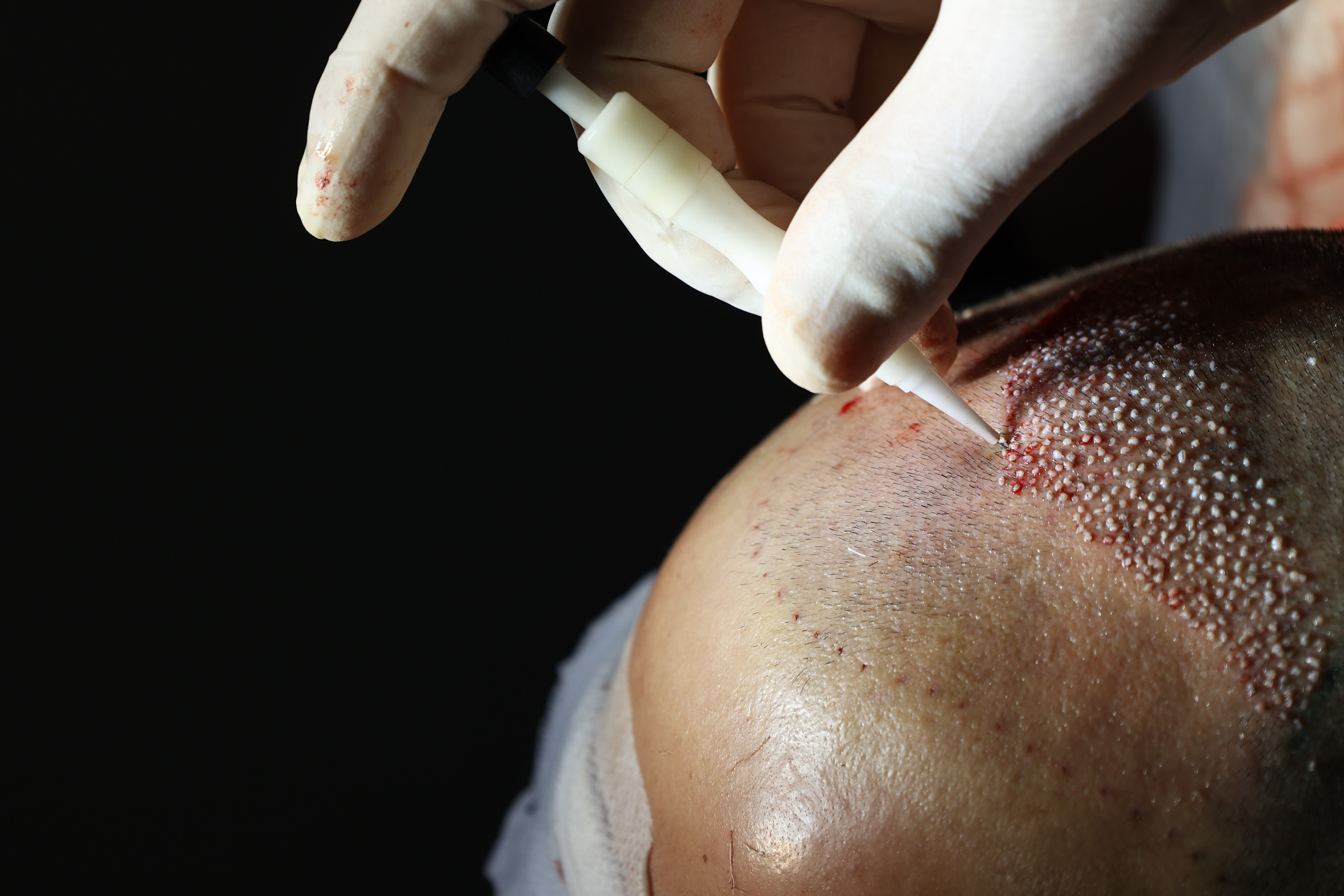 metoda me teknologjine DHI per mbjelljen e flokeve