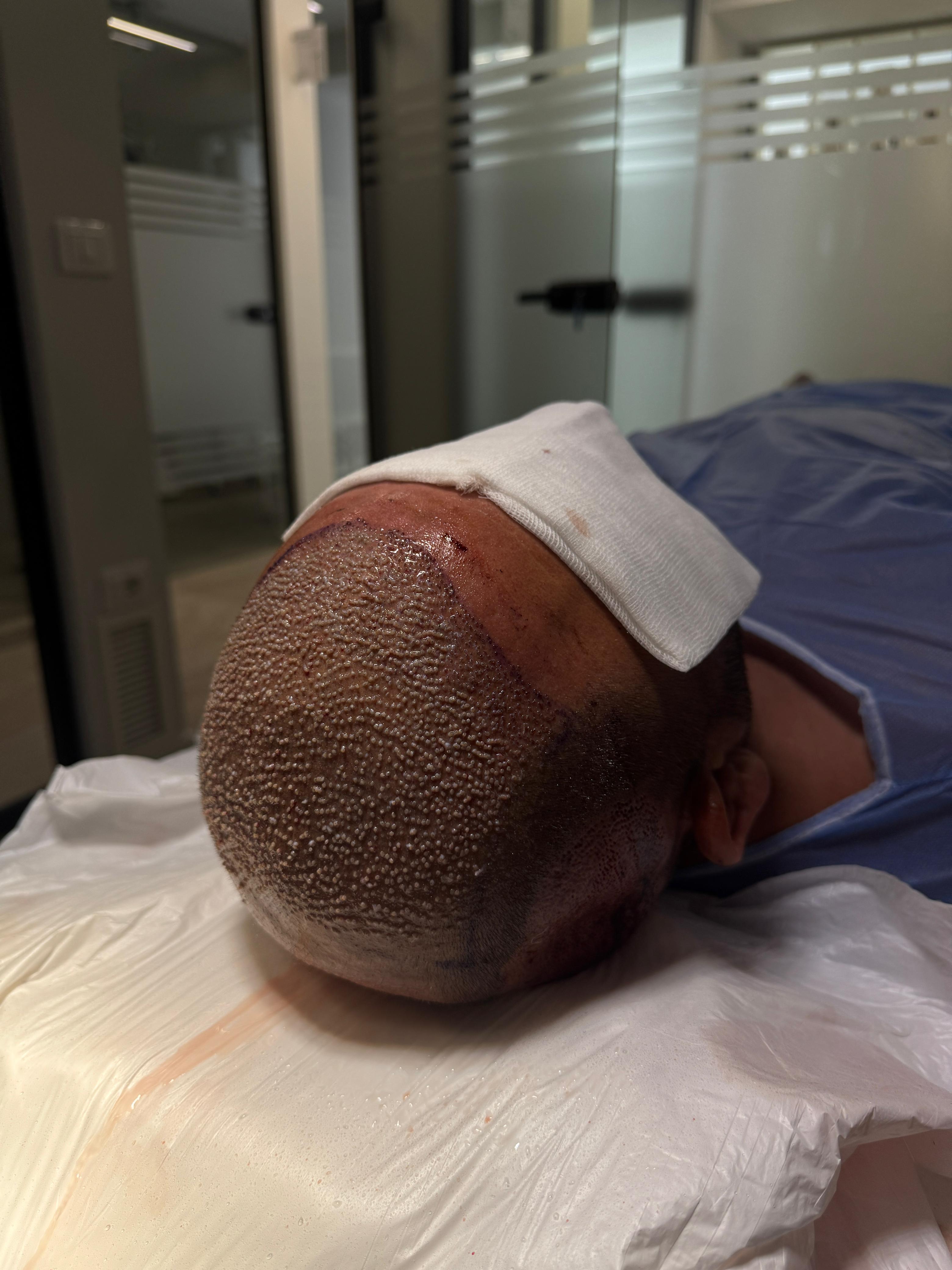 Teknika Sapphire FUE në klinikën Dermolife