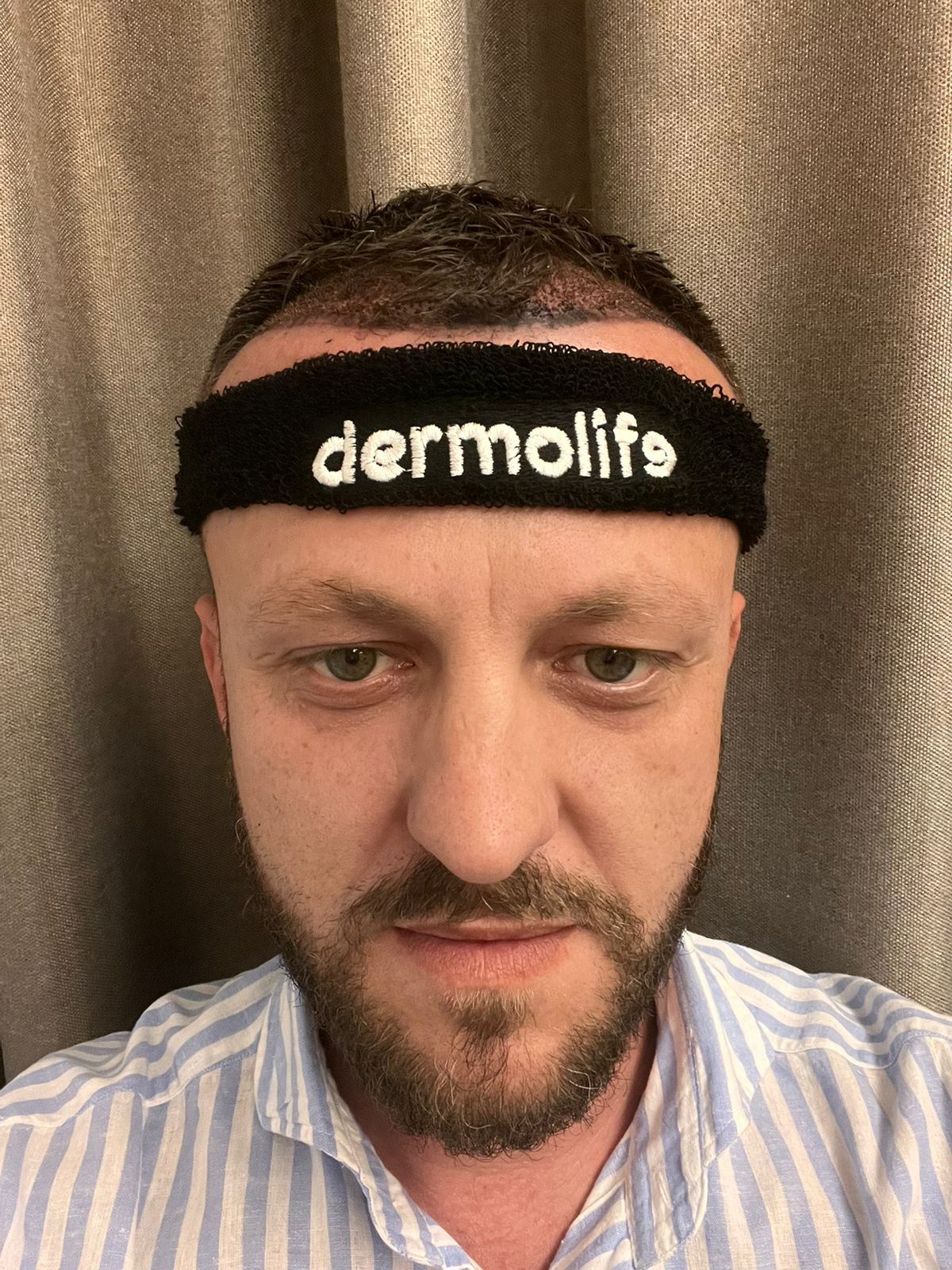 15 ditët e para pas transplantit të flokëve