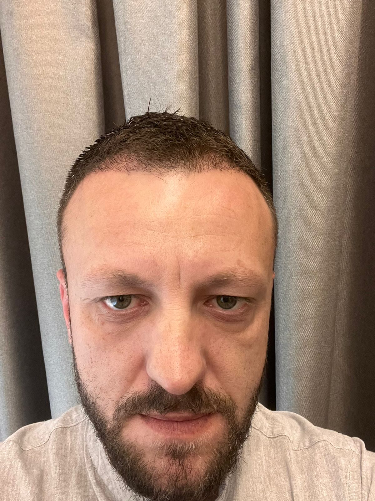 6 muaj pas transplantit të flokëve